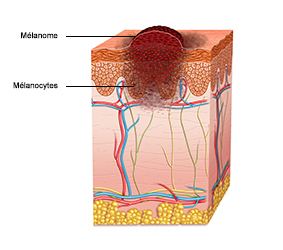 Diagram of the skin with a cancerous tumour